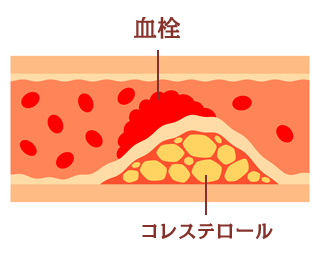 動脈硬化の図